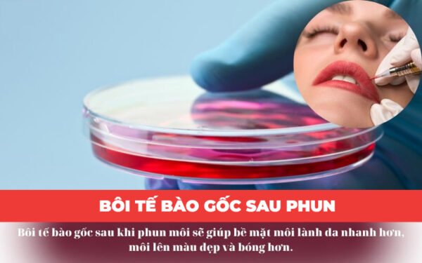 Có nên bôi tế bào gốc sau phun môi không?