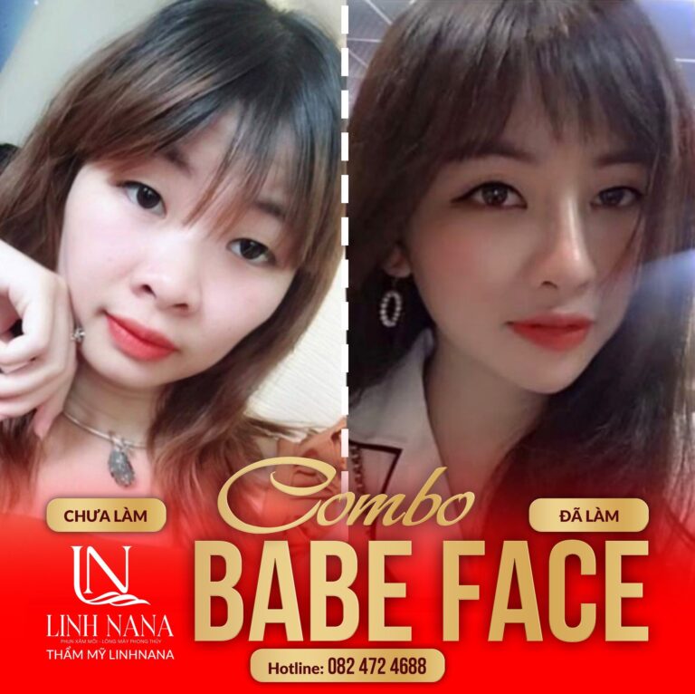 Khách hàng sử dụng dịch vụ cấy HA tại Khánh Xuân Beauty, Đông Gia Nghĩa – ảnh 01