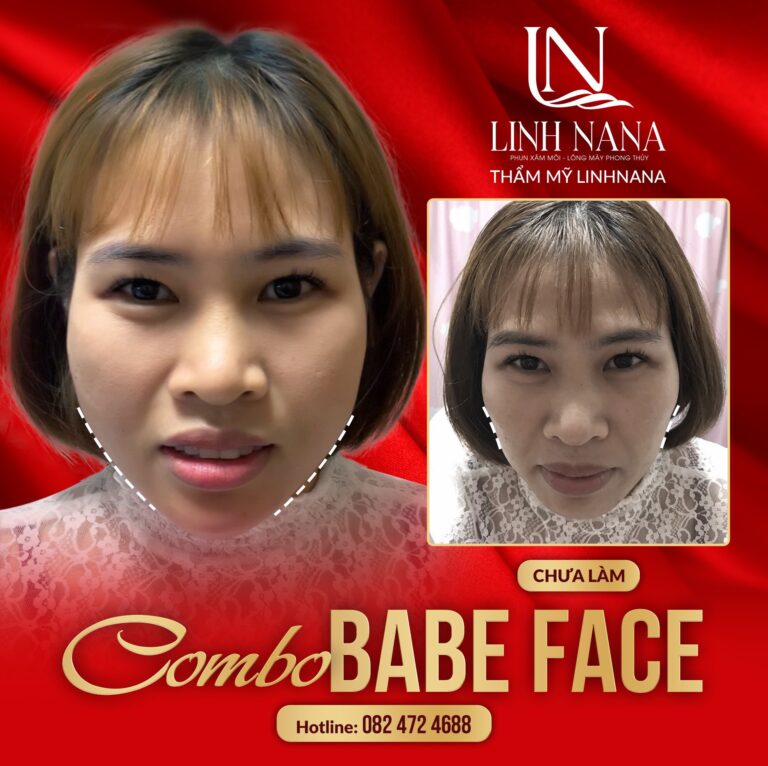 Khách hàng sử dụng dịch vụ cấy HA tại Khánh Xuân Beauty, Đông Gia Nghĩa – ảnh 05