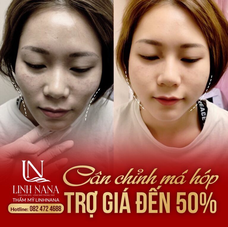 Khách hàng sử dụng dịch vụ cấy HA tại Khánh Xuân Beauty, Đông Gia Nghĩa – ảnh 06