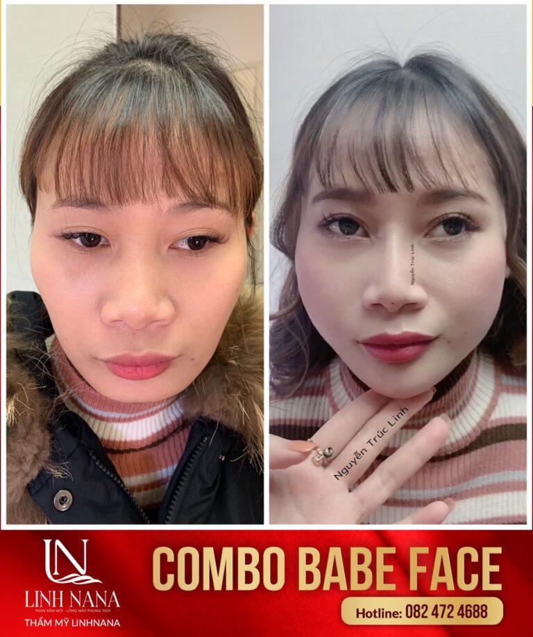 Khách hàng sử dụng dịch vụ cấy HA tại Khánh Xuân Beauty, Đông Gia Nghĩa – ảnh 08