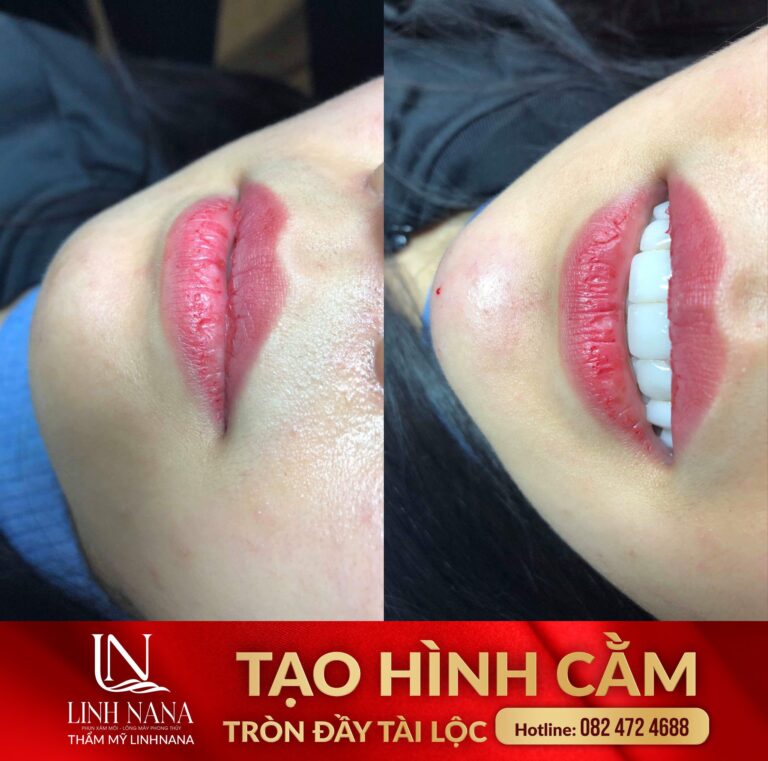 Khách hàng sử dụng dịch vụ cấy HA tại Khánh Xuân Beauty, Đông Gia Nghĩa – ảnh 09