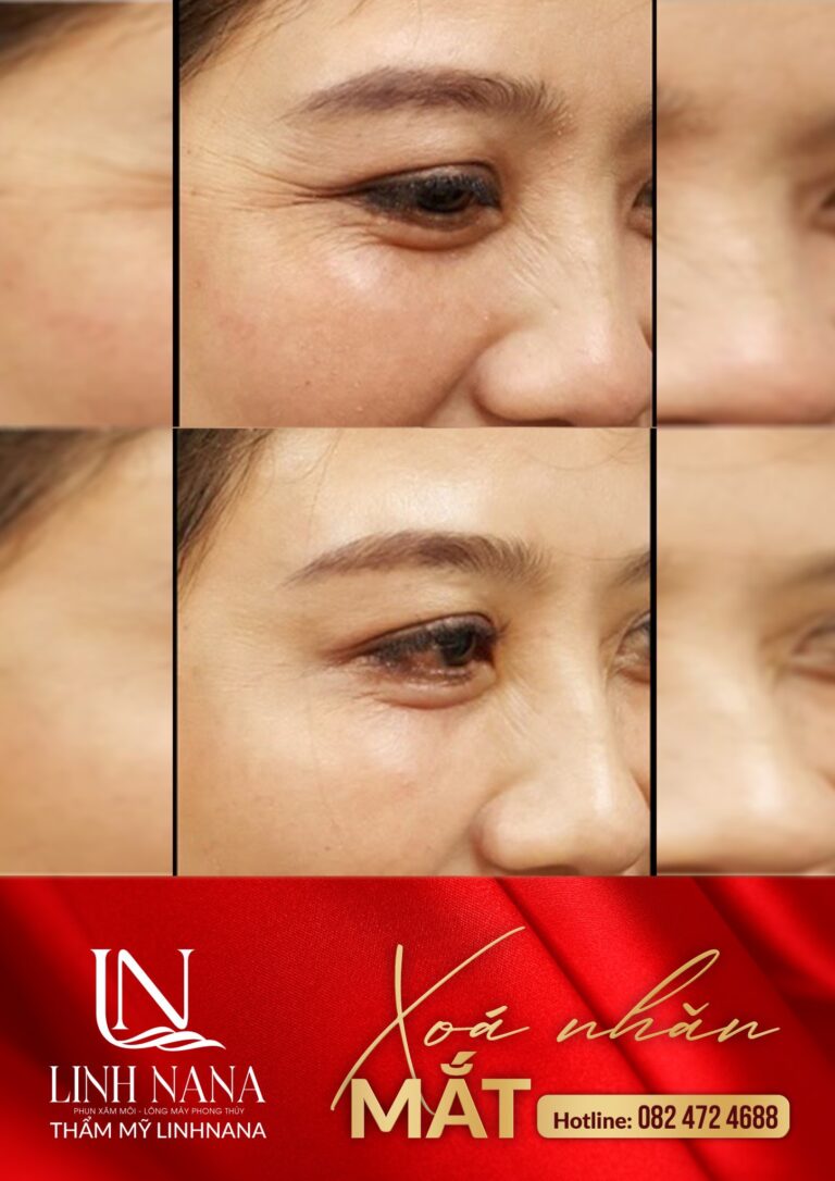 Khách hàng sử dụng dịch vụ cấy HA tại Khánh Xuân Beauty, Đông Gia Nghĩa – ảnh 11