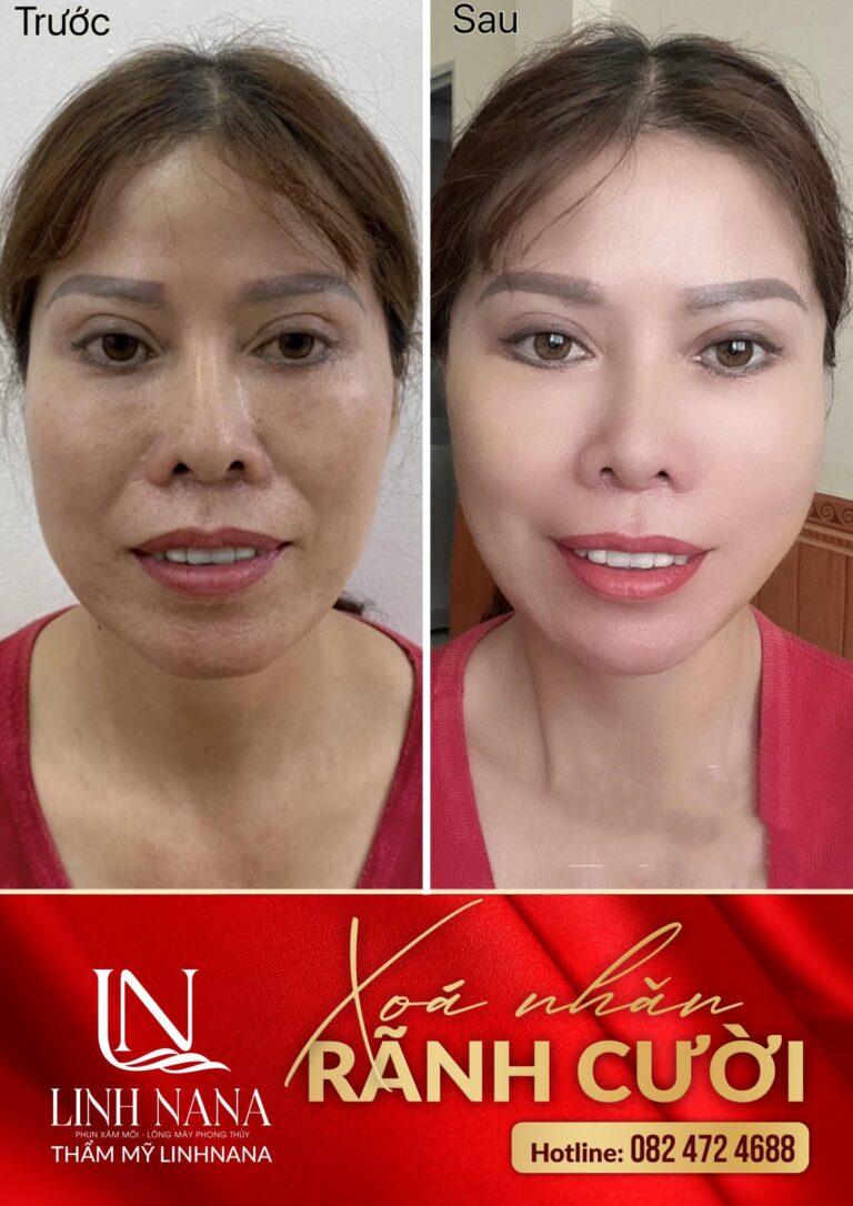 Khách hàng sử dụng dịch vụ cấy HA tại Khánh Xuân Beauty, Đông Gia Nghĩa – ảnh 12