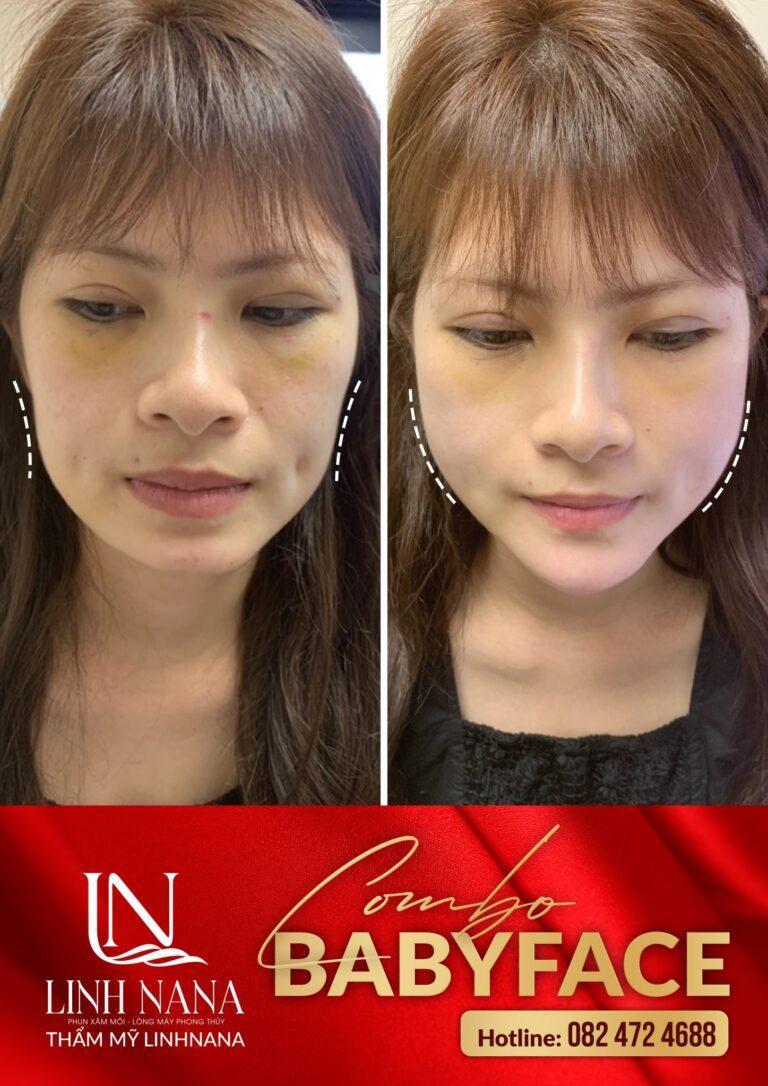 Khách hàng sử dụng dịch vụ cấy HA tại Khánh Xuân Beauty, Đông Gia Nghĩa – ảnh 13